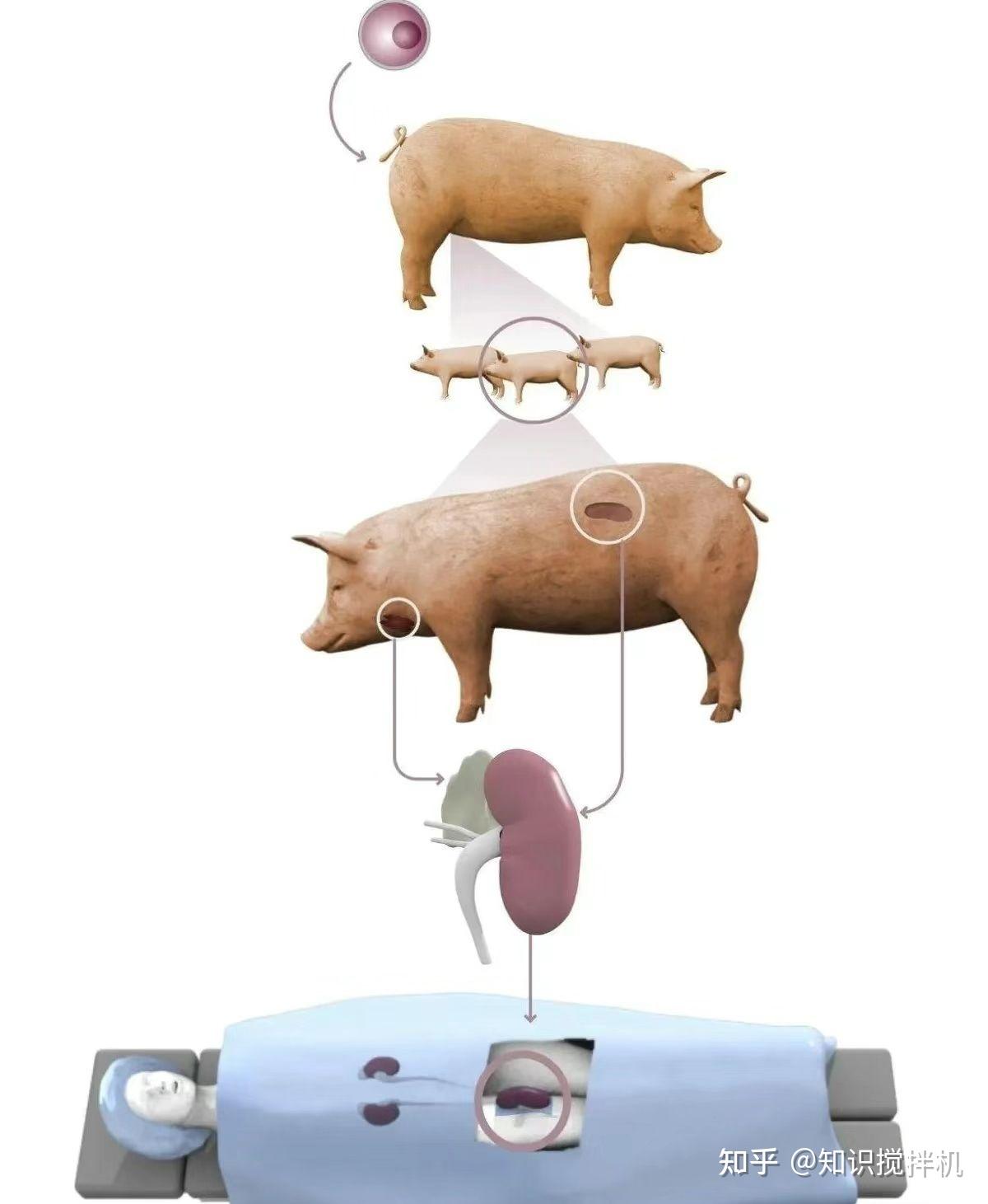 美国医生完成又一例基因编辑猪肾活体移植手术