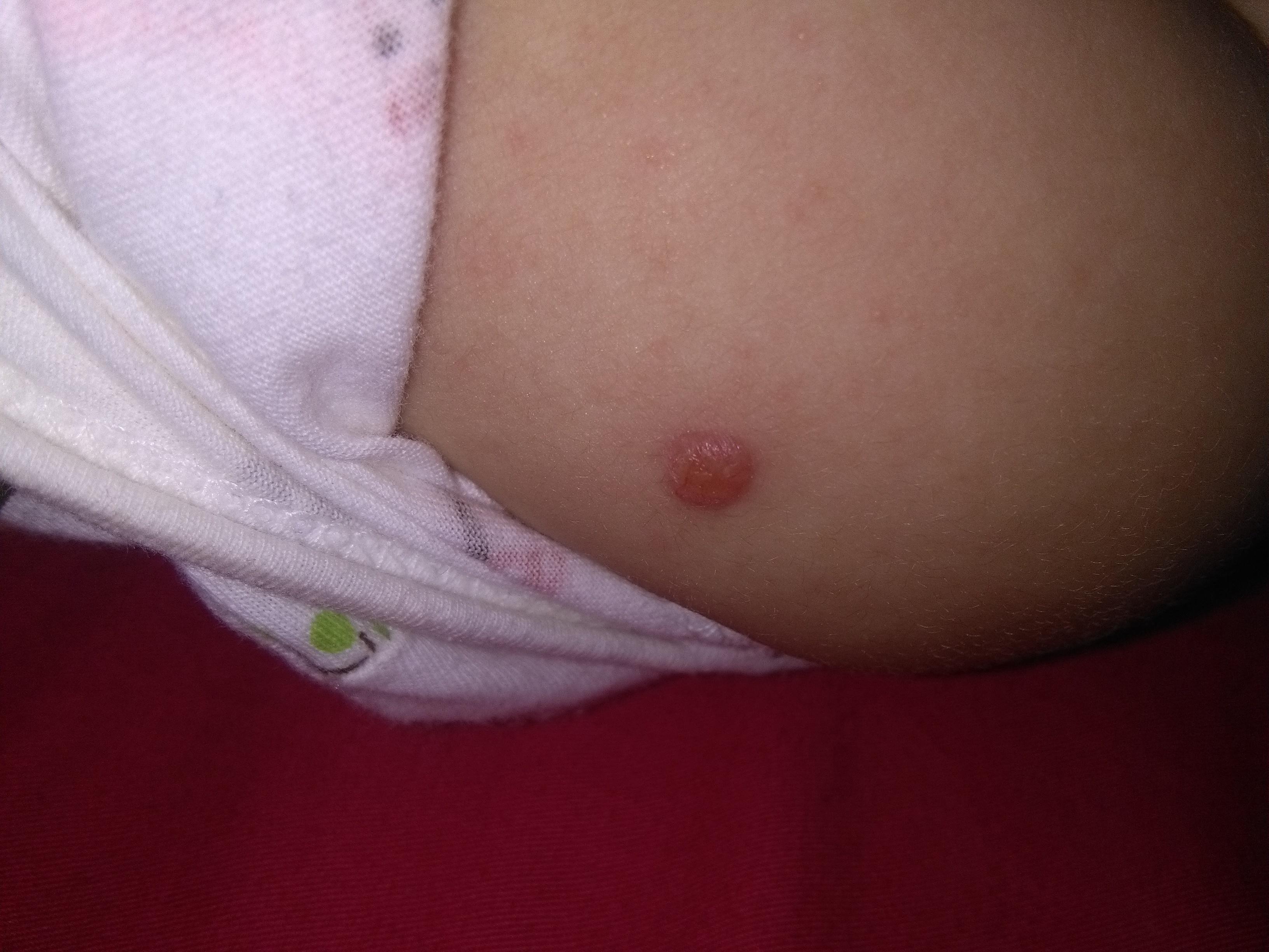 动物实验显示新型卡介苗可安全经静脉注射