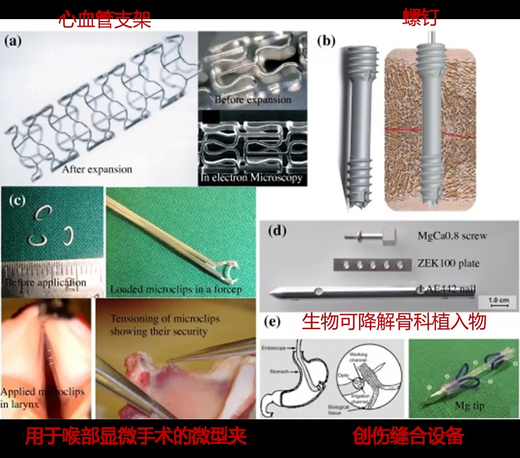 新型含镁修复材料获批上市带来骨损伤治疗新方案