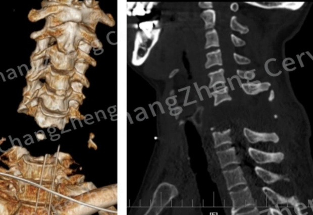 我国医生成功完成“身首离断”式颈椎手术