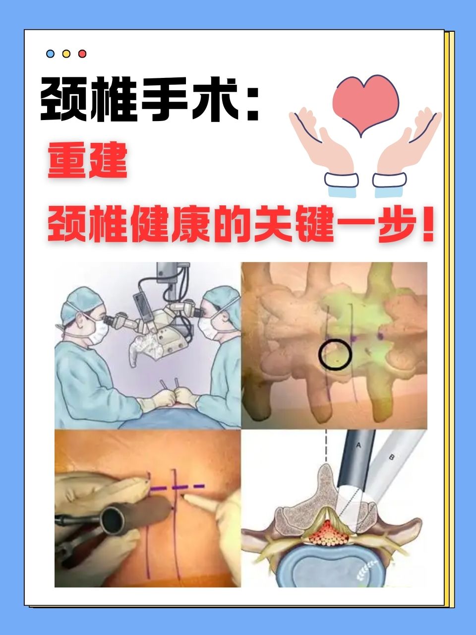 我国医生成功完成“身首离断”式颈椎手术